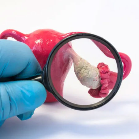 PCOS Management in Kanhangad