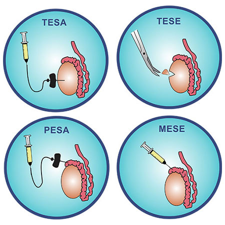 PESA, TESA, Micro TESE