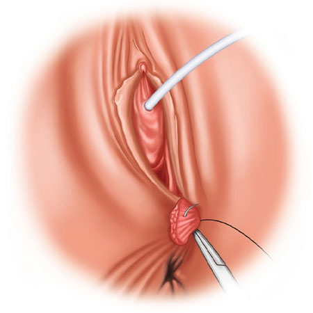 Perineoplasty in Kanhangad