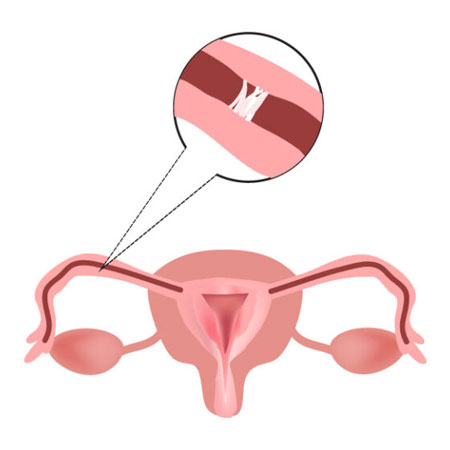 Sonosalpingography Treating in Kanhangad